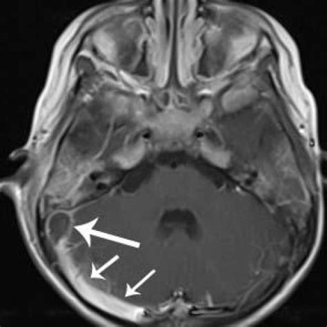 Sigmoid sinus thrombosis as a complication of acute mastoiditis | Eurorad