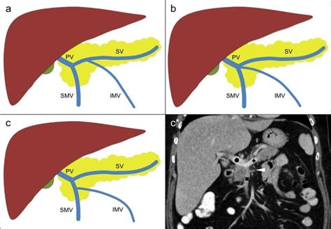 Anatomic variants of the inferior mesenteric vein (IMV): (a) the IMV... | Download Scientific ...