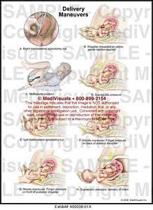 Delivery Maneuvers Medical Illustration Medivisuals