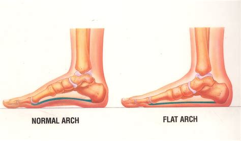 Custom Orthotics for Flat Feet (Pes Planus) | Abundant Life Health Centre - Markham Chiropractor