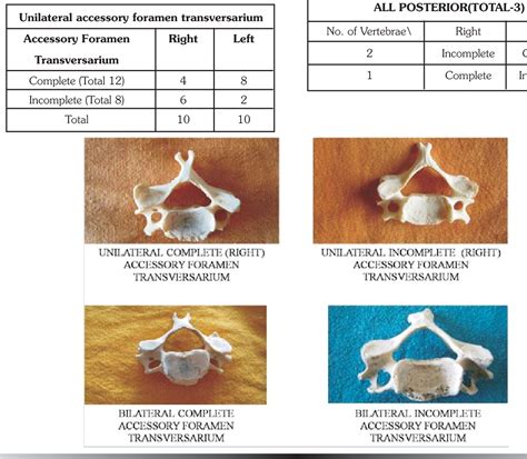 [PDF] Study of Accessory Foramen Transversarium in Cervical Vertebrae. | Semantic Scholar