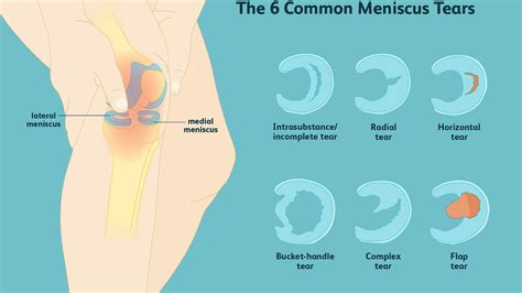 Meniscus Injury - Scottsdale Sports Medicine Institute