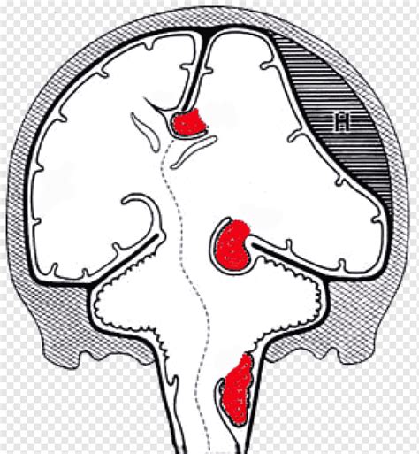 Hernia cerebral presión intracraneal uncus, cerebro, gente, cabeza, personaje de ficción png ...