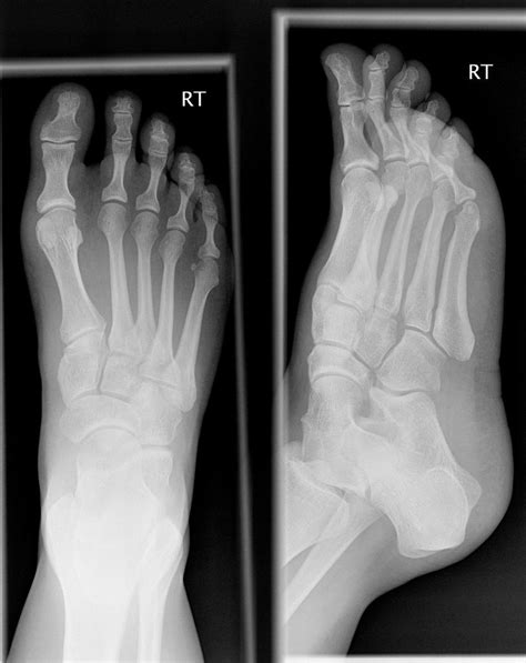 Normal Foot Anatomy