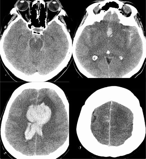 Ruptured ACOM aneurysm with Parenchymal Hemorrhage