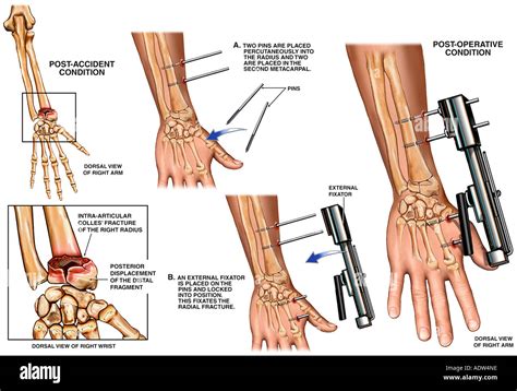 Post-accident Wrist Fracture with Application of External Fixator Stock Photo: 7711837 - Alamy