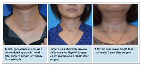 Hyperthyroidism Neck