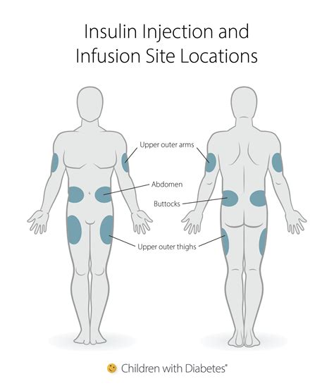 Why We Rotate Insulin Injections - Children with Diabetes