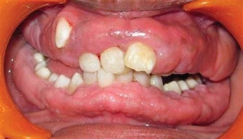 Gingival Hyperplasia - Pictures, Causes, Treatment, Dogs