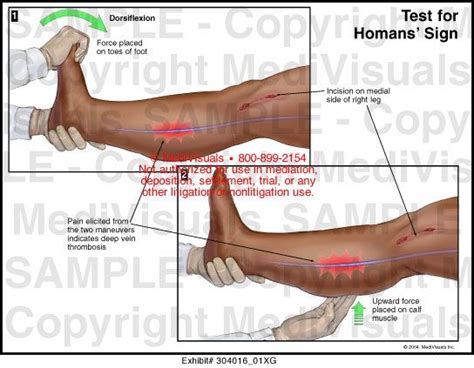 homans sign - Google Search | Occupational Therapy: Assessments ...