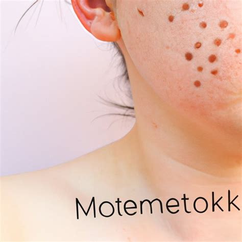 What is Mottling of the Skin? Causes, Symptoms and Treatment - The Knowledge Hub