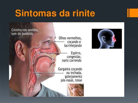 Sinusite e Rinite - Como Cuidar Receita Caseira