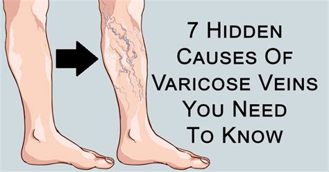 7 Hidden Causes Of Varicose Veins You Need To Know - David Avocado Wolfe