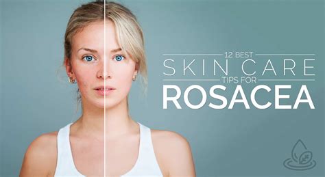 12 Best Skin Care Tips For Rosacea – Positive Health Wellness