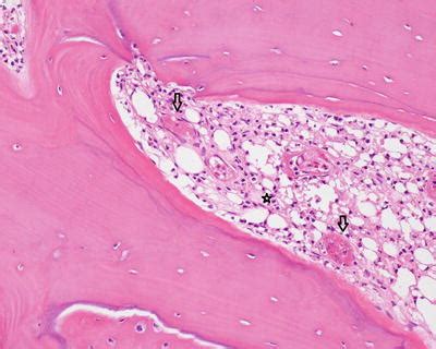 Pathologic Diagnosis of Osteomyelitis | Musculoskeletal Key