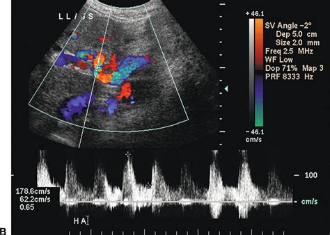 Ultrasound Evaluation of the Portal and Hepatic Veins | Thoracic Key