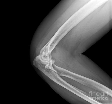 Broken Elbow, X-ray #3 Photograph by Science Photo Library - Fine Art ...