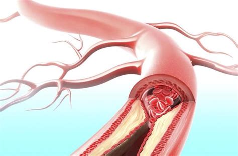 Atherosclerosis Symptoms | medica-ad.co.jp