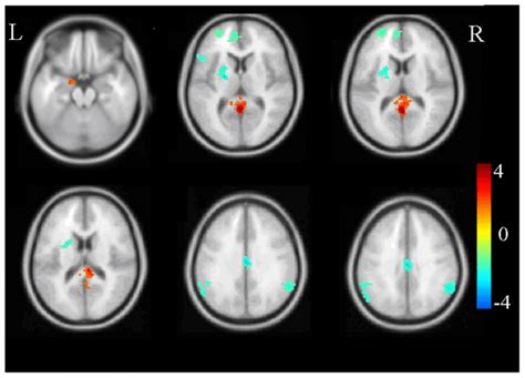 PTSD Brain Scans Fall Short for Diagnosis - Once A Soldier