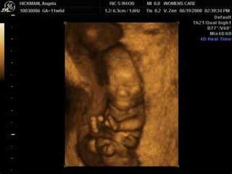 12 week ultrasound 3D/4D baby - YouTube