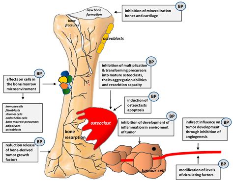 Bone cancer painful - lasopabuster