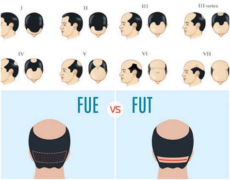 What´s The Big Difference Between FUT and FUE Hair Transplant Techniques?