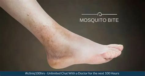 What is the possible reasons for the leg swelling due to mosquito bite?