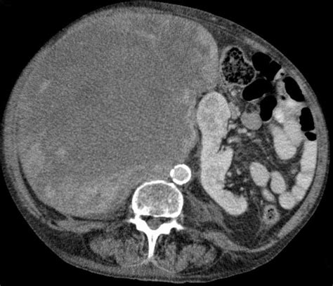 retroperitoneal liposarcoma A retroperitoneal mass was detected in this ...