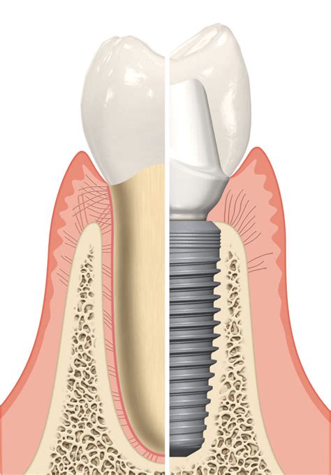 Immediate implant placement