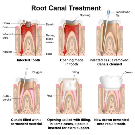 Root Canal Orlando, FL - Windermere Dental Group