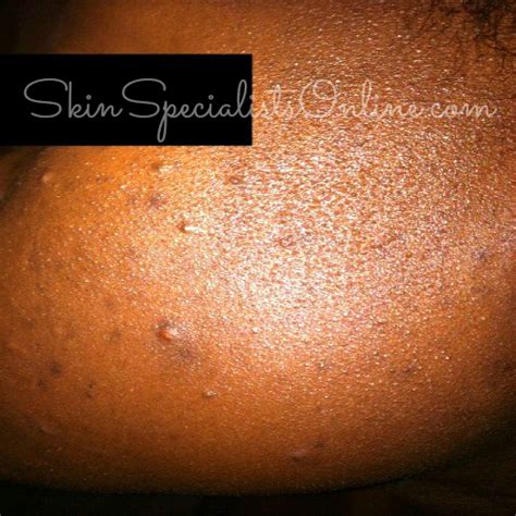 Ask a Skin Specialist: Acneiform Eruptions - Skin Specialists Online