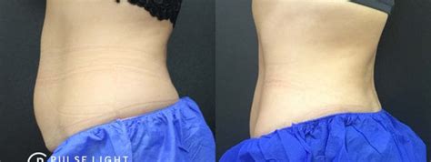 Fat Freezing Before and After | Pulse Light Clinic London