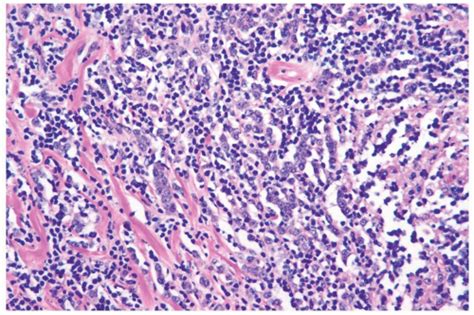 Invasive Lobular Carcinoma | Basicmedical Key