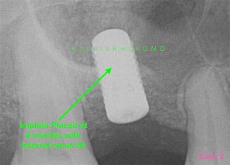 bone-grafting-for-dental-implants-x-ray-6 | San Diego Periodontics ...