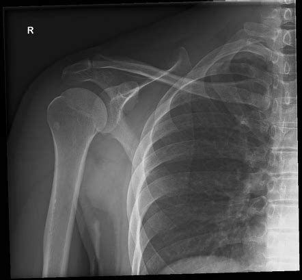 Normal scapular series | Radiology Case | Radiopaedia.org