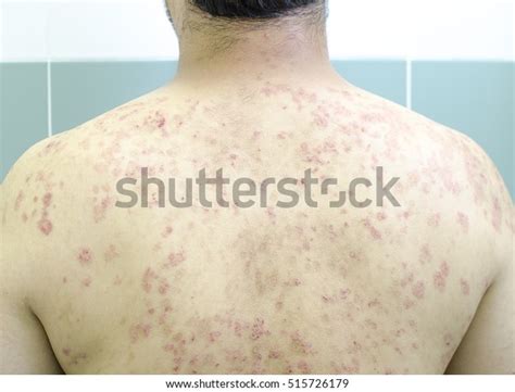 Psoriasis Autoimmune Disease That Affects Skin Stock Photo 515726179 | Shutterstock