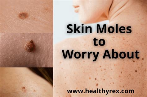 Skin Moles to Worry About – A Complete Guide With Skin Moles Pictures