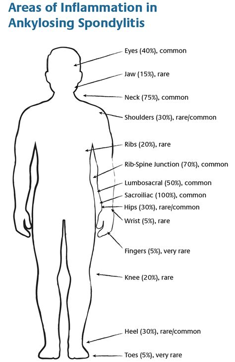 Ankylosing Spondylitis - Causes, Symptoms, Exercises, Treatment