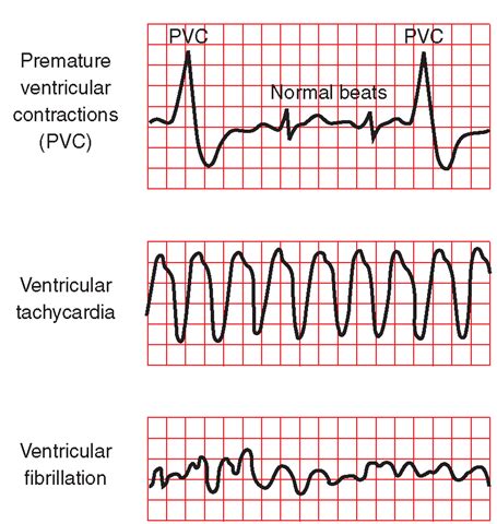 3 Common Arrhythmias | Nursing school survival, Cardiac nursing, Nurse