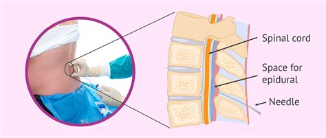What space does an epidural go into?