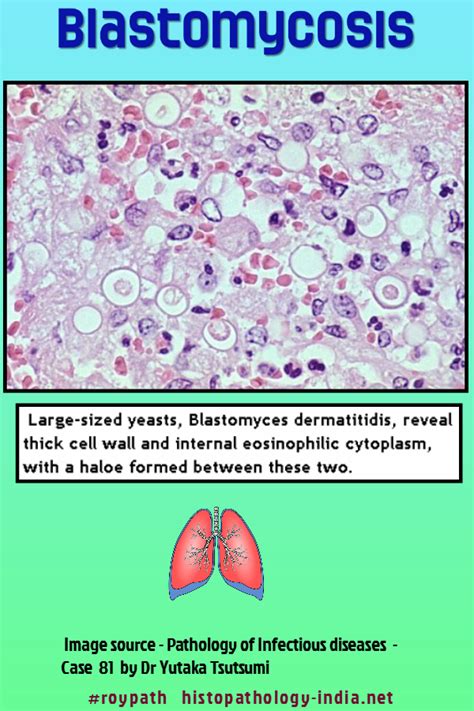 Pathology of Blastomycosis | Pathology, Cell wall, Infectious disease