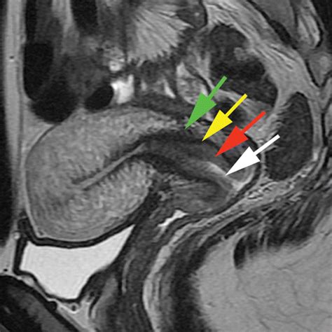 Early Cervical Carcinoma and Fertility-sparing Treatment Options: MR Imaging as a Tool in ...