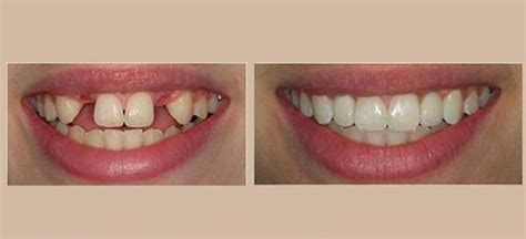 Types of Partial Dentures: Maritza O Jenkins, DMD: General Dentist