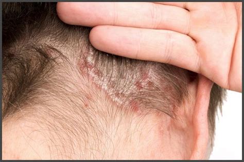 Psoriasis on neck pictures | Psoriasis expert