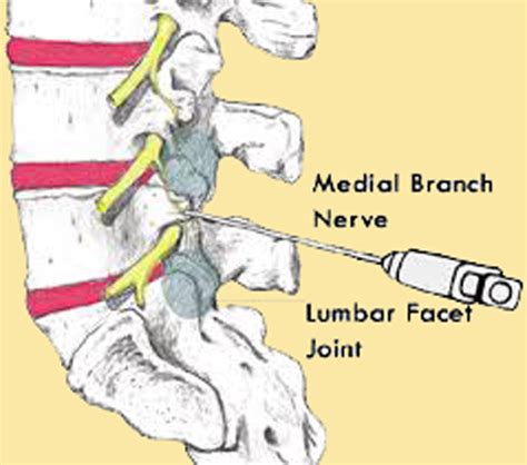 Medial Branch Block – iSPINE