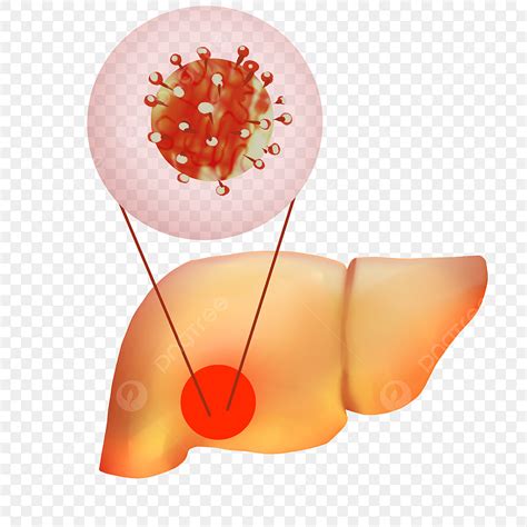 Hepatitis Virus PNG Picture, Liver Hepatitis Virus Infection, Human Body, Internal Organs, Liver ...