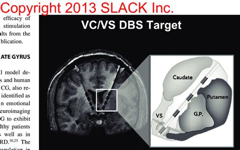 The location of the ventral capsule/ventral striatum (VC/VS) deep brain ...