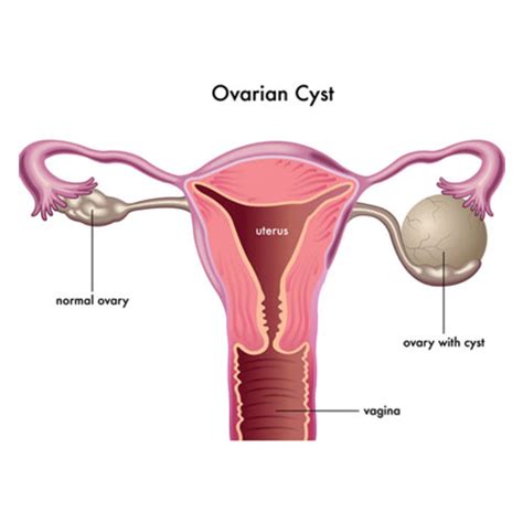 Ovarian Cysts Removal using Laparoscopy | Dr. Deepa Ganesh