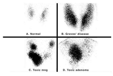 Iodine 123 nuclear scintigraphy: scans of a normal thyroid gland (A) and common hyperthyroid ...