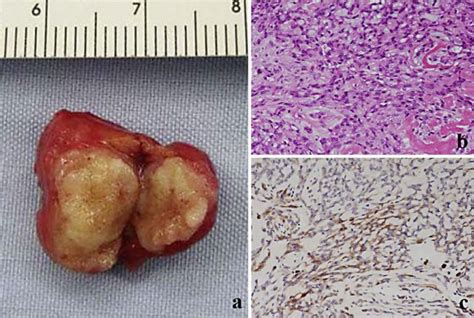 a Gross appearance of the tumor, b microscopic appearance of the tumor ...